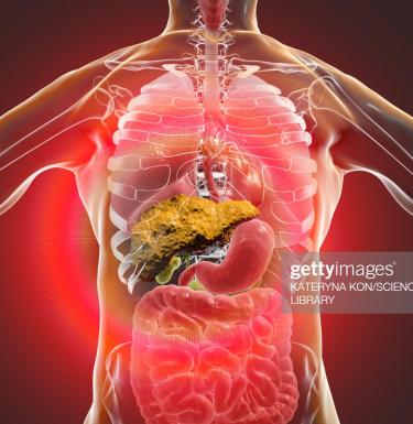  An illustration of a human liver with cirrhosis. Kateryna Kon/Science Photo Library