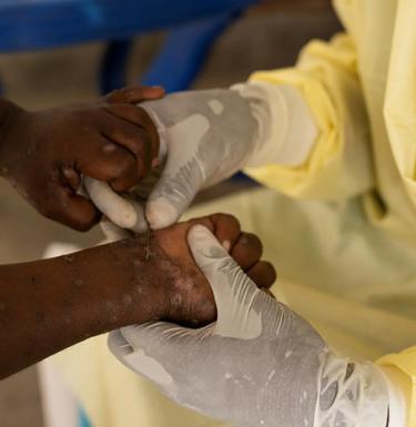 A nurse takes a sample from a child who potentially has mpox.