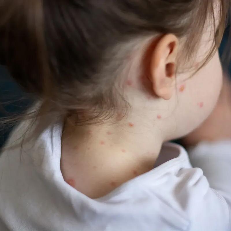 child with measles